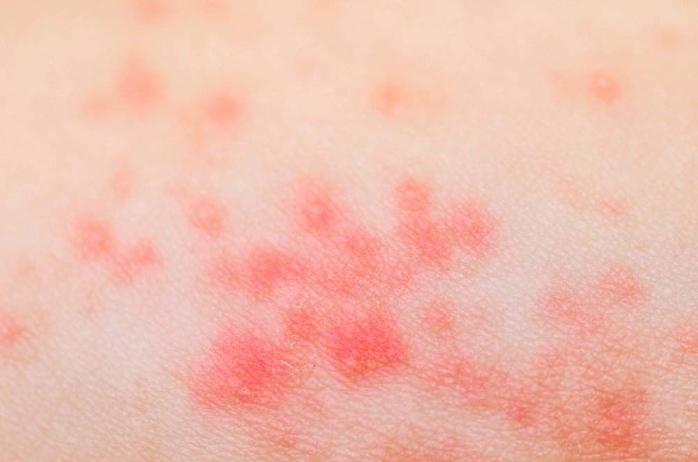 Arm Rash - Symptoms, Causes, Treatments - Healthgrades