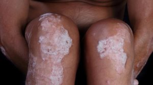 Bilde: Psoriasis