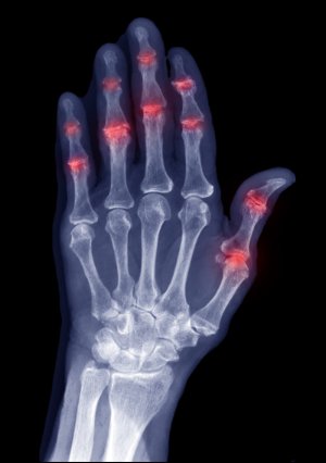Bilde: Artritis psoriásica