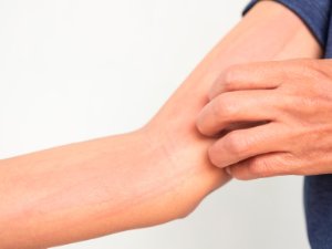 Bilde: Verdens urtikariadag