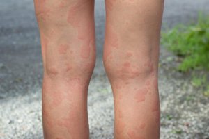 Bilde: Urticaria crónica